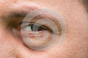 Eyesore, inflammation or bag swelling under eye