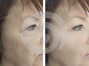 Face adult an elderly woman cosmetology revitalization difference pigmentation removal before and after treatment