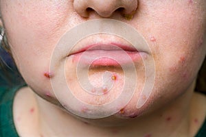 Face of adult woman with smallpox disease has red pimples on skin.