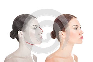 Woman in profile with Before and after mentoplasty and rhinoplasty photo