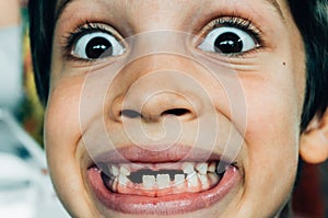 Face of boy smiling with missing teeth