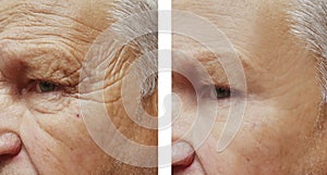 Starší muž čelo vrásky terapie před a po postupy 
