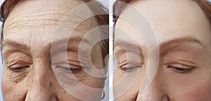 Face of an elderly surgery woman wrinkles results dermatology treatment face collagen ,before and after procedures