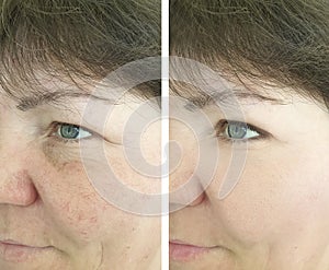Face  couperose of an elderly aging    patient  treatment wrinkles before and after procedures