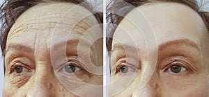 Face elderly woman forehead wrinkles before and after cosmetic procedures