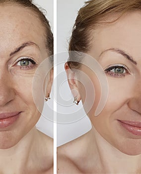 Face elderly woman wrinkles before and after cosmetic procedures collagen