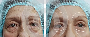 Face of an elderly woman regeneration wrinkles contrast removal on the face before and after procedures, arrow