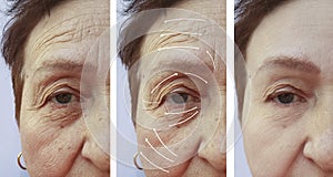 Face, elderly woman, wrinkles, plastic filler difference patient contrast correction before and after procedures, arrow photo