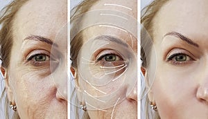Face, elderly woman, wrinkles, correction removal collagen before and after procedures, arrow