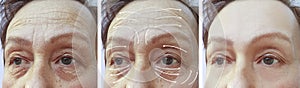 Face, elderly woman, wrinkles, cosmetology contrast correction before and after procedures, arrow