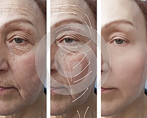 Face, elderly woman, wrinkles, cosmetology correction before and after procedures, arrow