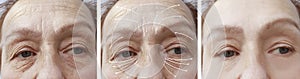 Face, elderly woman, wrinkles, cosmetology patient contrast correction before and after procedures, arrow