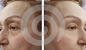 Face of an elderly woman wrinkles dermatology procedure before and aftetherapy r