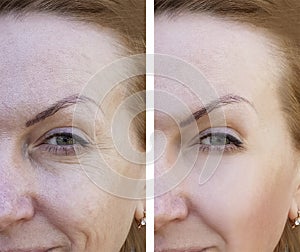 Face of an elderly woman wrinkles dermatology procedure procedure before and aftetherapy r