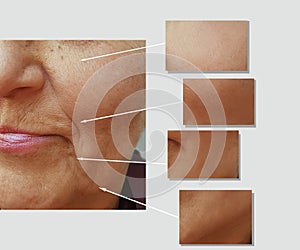 Face of an elderly surgery woman wrinkles plastic correction dermatology treatment face collagen ,before and after procedures