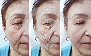 Face, elderly woman, wrinkles, filler cosmetology patient contrast correction before and after procedures, arrow