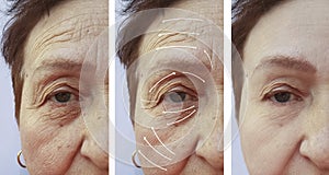 Face, elderly woman, wrinkles, plastic filler difference patient contrast correction before and after procedures, arrow