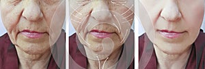 Face, elderly woman, wrinkles, plastic filler patient contrast correction before and after procedures, arrow