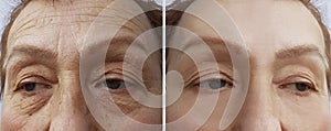 Face of an elderly woman wrinkles procedure before and aftetherapy r