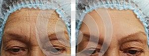 face of an elderly woman wrinkles therapy clinical before and after procedures