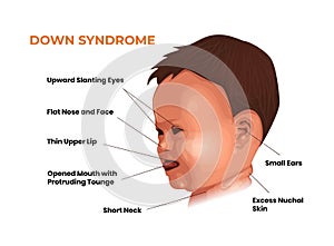 Face features of the baby with Down syndrome. Trisomy 21 symptoms