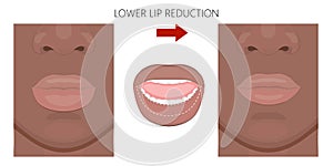 Face front_African American Lower Lip reduction