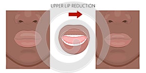 Face front_African American Upper Lip reduction