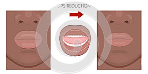 Face front_African American Upper and Lower Lips reduction