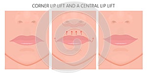 Face front_Corner Lip Lift AND a central lip lift