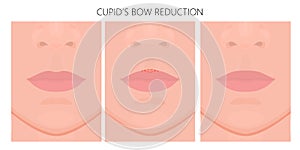 Face front_Cupid Bow Reduction 1