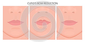 Face front_Cupid Bow Reduction 2