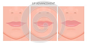 Face front_Lip advancement