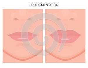 Face front_Lip Augmentation