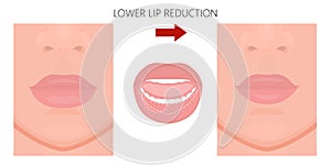Face front_Lower Lip reduction