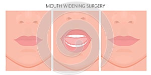 Face front_Mouth Widening Surgery