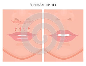 Face front_ Subnasal lip lift