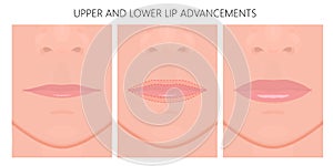 Face front_Upper and Lower Lip Advancements