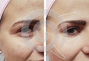 Face girl eyes wrinkles swollen biorevitalization regeneration before and after difference procedures