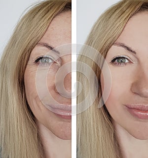 Face girl wrinkle before and after cosmetic procedures