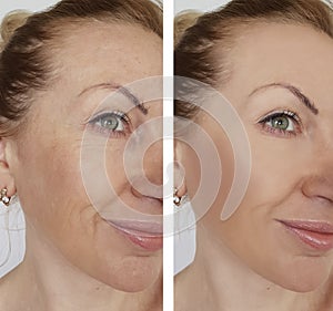 Face girl wrinkle before and after effect correction cosmetic procedures