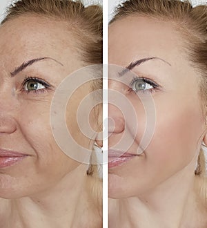 Face girl wrinkle before and after lifting correction cosmetic procedures