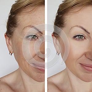 Face girl wrinkle before and after treatment correction cosmetic procedures