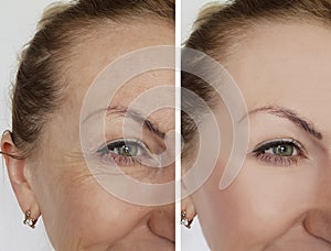 Face girl wrinkles before and after correction rejuvenation cosmetic procedures