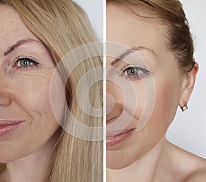 Face girl wrinkles before and after cosmetic procedures