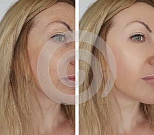 Face girl wrinkles before and after cosmetic procedures