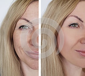 Face girl wrinkles before and after cosmetic therapy procedures