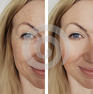 Face girl wrinkles before and after lift results lifting facial procedures