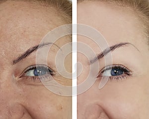 Face girl wrinkles before and after lifting facial cosmetic procedures