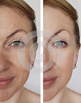 Face girl wrinkles before and after lifting rejuvenation cosmetic procedures