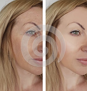 Face girl wrinkles before and after therapy cosmetic procedures